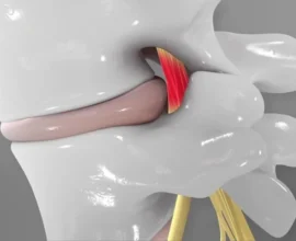 Pinched Nerve
