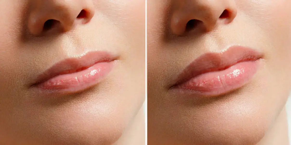 Lip Flip Before and After