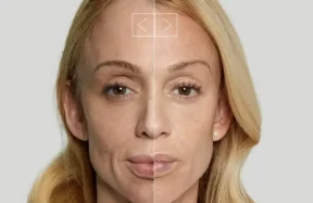 Sculptra Before and After